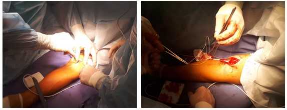 отрыв бицепса операция