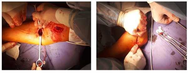 отрыв бицепса восстановление сухожилия