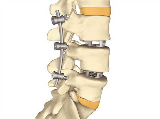 Транспедикулярная фиксация позвоночника