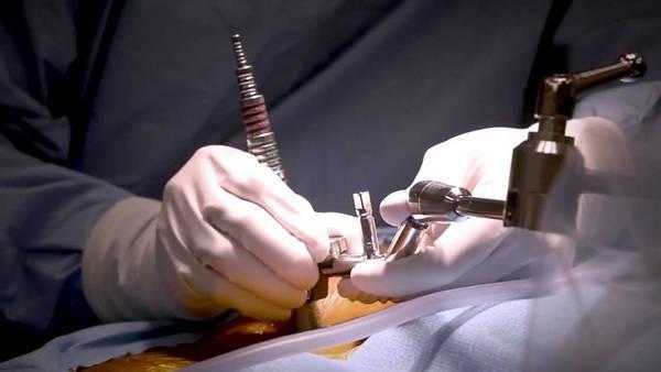 Ламинэктомия позвоночника