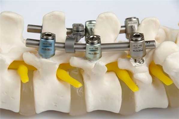 Противопоказания к траспедикулярной фиксации