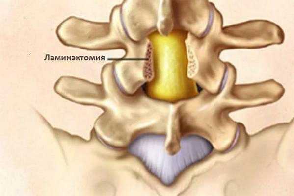 Показаний для проведения ламинэктомии довольно много