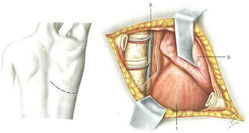 Схема трансплеврального доступа к грудопоясничному отделу позвоночника 1 - диафрагма; 2 плевральная полость; 3 - легкое.