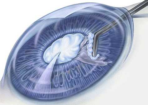 Появление вторичной катаракты после замены хрусталика: причины