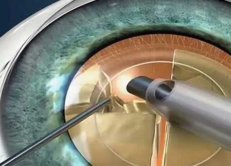 Удаление хрусталика