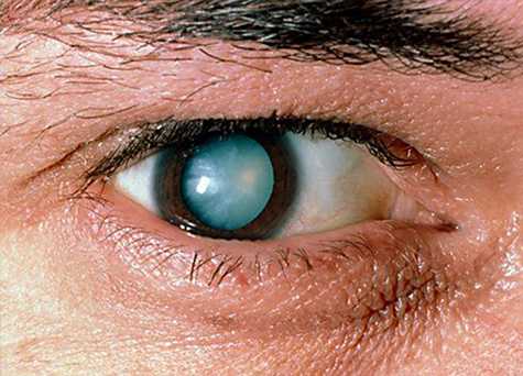 Хирургическое лечение катаракты в Москве