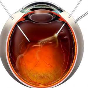 Передняя витрэктомия