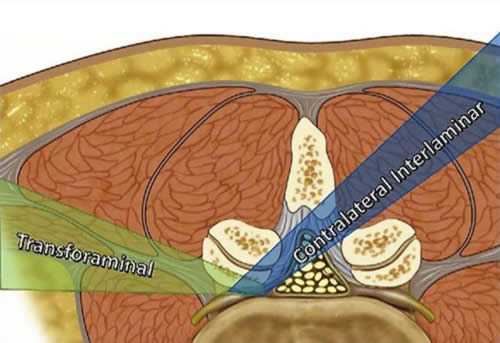 Экстрафораминальный и интерламинарный (контралатеральной) доступ при фораминотомии. Интраламинарная фораминотомия позволяет провести декомпрессию боковой выемки, фораминального (межпозвонкового) отверстия, но не может декомпрессировать экстрафораминальную зону.