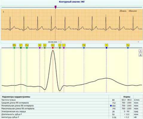 Контурный анализ ЭКГ: анализ сердечного ритма