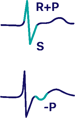 Контурный анализ ЭКГ: анализ сердечного ритма