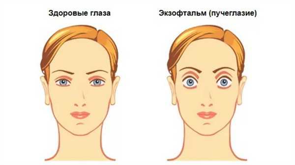 Пучеглазие