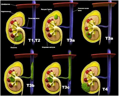 Классификация рака почки TNM