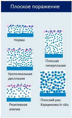 Плоские новообразования