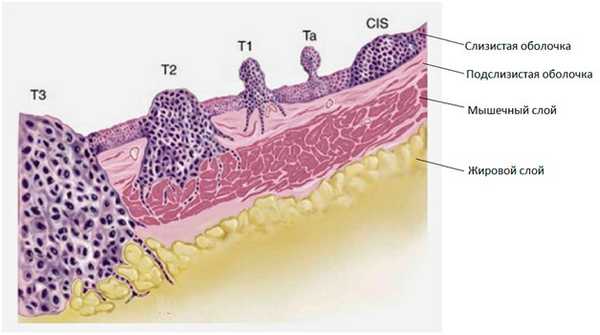 Распространенность опухоли