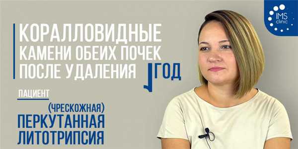Коралловидные цистиновые камни. Через год после перкутанного удаления крупных камней почек (видео)