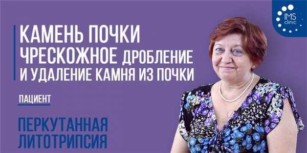 Камень почки. Чрескожное дробление и удаление камня из почки. Видео отзыв