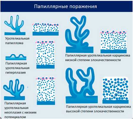 Папиллярные новообразования