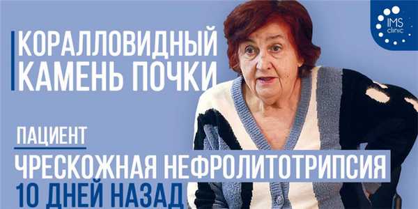 Коралловидный камень почки. Чрескожная нефролитотрипсия 10 дней назад. Видео отзыв
