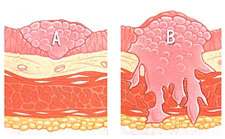 Неинвазивная опухоль