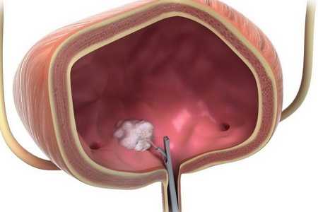 Опухоль (рак) мочевого пузыря
