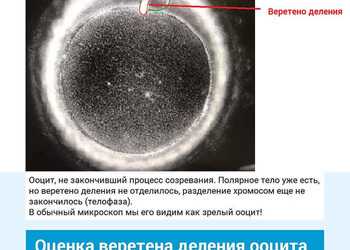 Оценка веретена деления яйцеклетки. Клиника ЭКО Альтравита.
