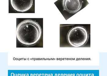 Оценка веретена деления яйцеклетки. Клиника ЭКО Альтравита.