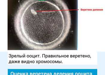 Оценка веретена деления яйцеклетки. Клиника ЭКО Альтравита.