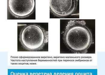 Оценка веретена деления яйцеклетки. Клиника ЭКО Альтравита.