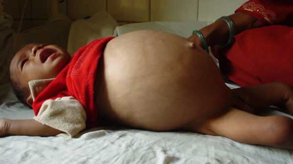 Вздутый живот у ребенка