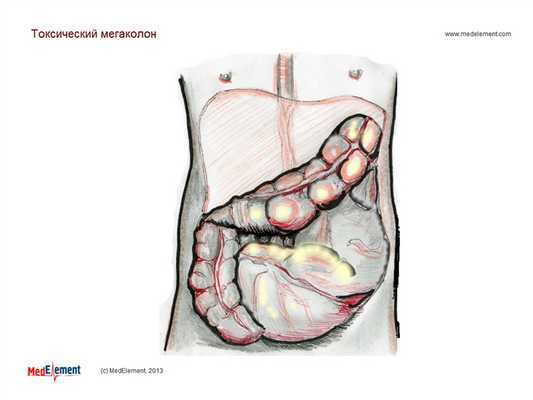 Вздутый кишечник