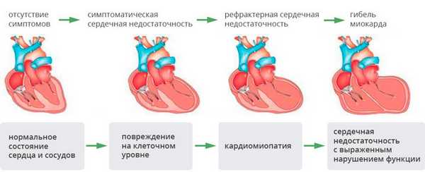 Степени тяжести сердечной недостаточности