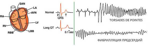 Аритмия как проявление кардиотоксичности