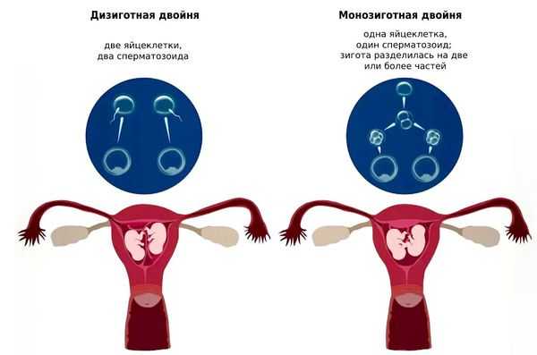 Дизиготная и монозиготная двойни