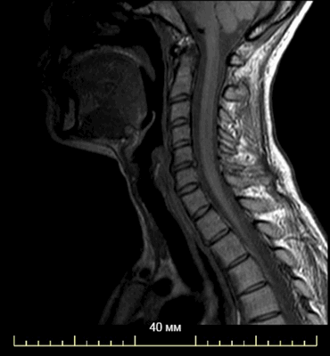 МРТ области шеи
