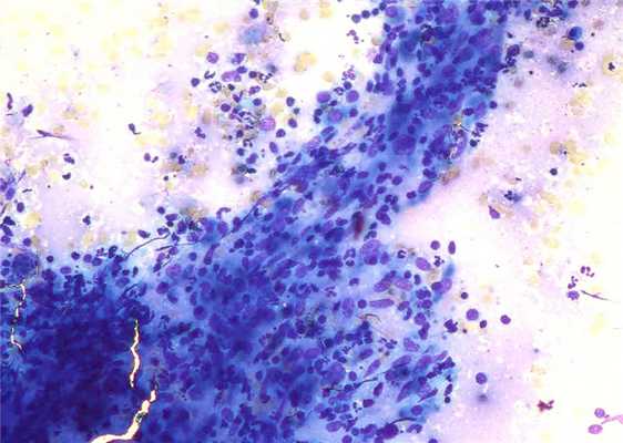 Стандартная биопсия щитовидной железы