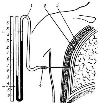 Рис. 2. Схематическое изображение этапа наложения искусственного пневмоторакса (фронтальный разрез): 1 — манометр (показывает отрицательное давление в плевральной полости); 2 — париетальная плевра; 3 — висцеральная плевра; 4 — игла (конец иглы находится в плевральной полости).