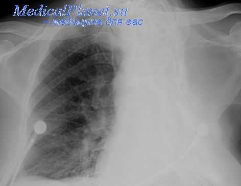 торакопластика