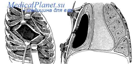 торакопластика