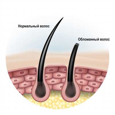 Трихотилломания