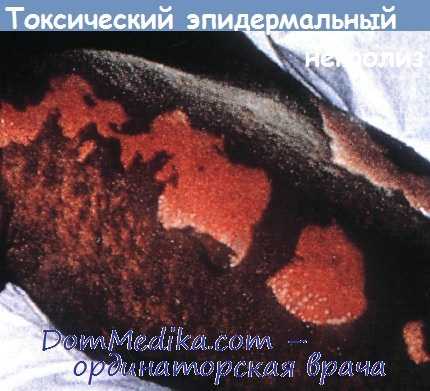 токсический эпидермальный некролиз при РТПХ