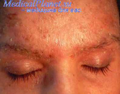 реакция трансплантат против хозяина - РТПХ