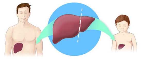 Пересадка печени