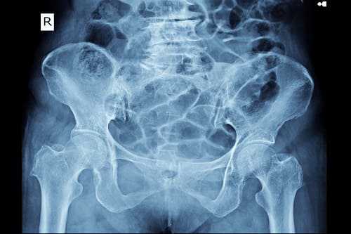 Рентгеновская диагностика неврита бедренного нерва