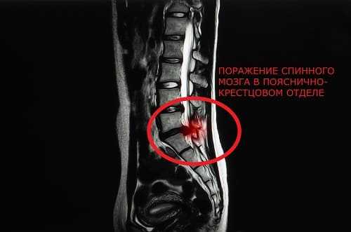 Причина ишиаса на КТ