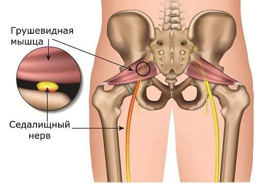 Синдром грушевидной мышцы - боль в седалищном нерве