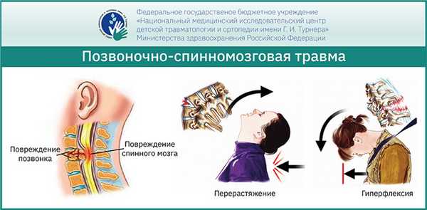 Позвоночно-спинномозговая травма у детей и подростков