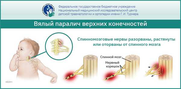 Вялые параличи у детей и подростков — комплексное лечение, инновационные методики