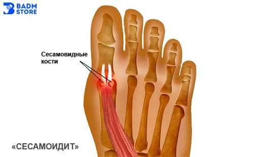 Боли в сесамовидной кости в бадминтоне