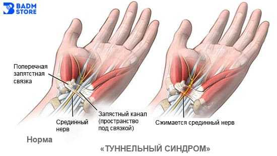 туннельный синдром в бадминтоне