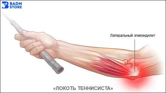 Локоть теннисиста - эпикондилит в бадминтоне